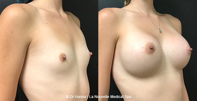 breast augmentation with silicone implants Ventura County, before after photos sideview by dr. Hanna, La Nouvelle Medical Spa, side view