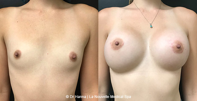 breast augmentation with silicone implants Ventura County, before after photos by dr. Hanna, La Nouvelle Medical Spa, front view