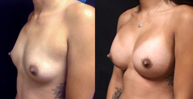 breast augmentation with silicone implants before after photos by dr. Hanna, La Nouvelle Medical Spa, Oxnard, Ventura County, 51 sideview 