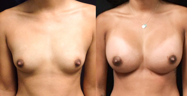 breast augmentation with silicone implants before after photos by dr. Hanna, La Nouvelle Medical Spa, Oxnard, Ventura County, 51