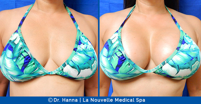 breast augmentation with silicone implants before after photos by dr. Hanna, La Nouvelle Medical Spa, Oxnard, Ventura County, 52 