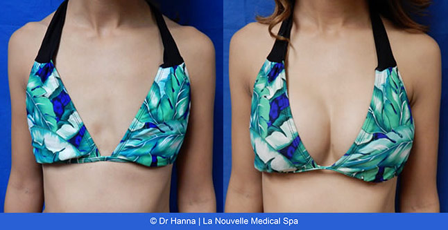 breast augmentation with silicone implants before after photos by dr. Hanna, La Nouvelle Medical Spa, Oxnard, Ventura County, front view 1 