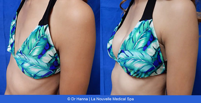 breast augmentation with silicone implants before after photos by dr. Hanna, La Nouvelle Medical Spa, Oxnard, Ventura County, sideview2 