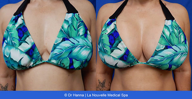 breast augmentation with silicone implants before after photos by dr. Hanna, La Nouvelle Medical Spa, Oxnard, Ventura County, frontview 