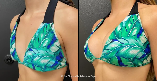 breast augmentation with silicone implants before & after photos, Ventura County, Los Angeles, Thousand Oaks