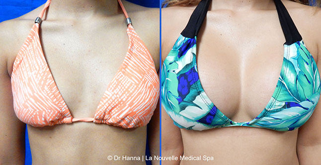 breast augmentation with silicone implants before after photos by dr. Hanna, La Nouvelle Medical Spa, Oxnard, Ventura County, 11