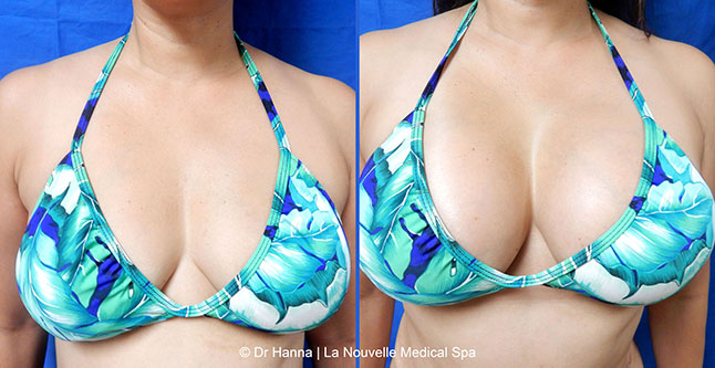 breast augmentation with silicone implants before after photos by dr. Hanna, La Nouvelle Medical Spa, Oxnard, Ventura County, 12 