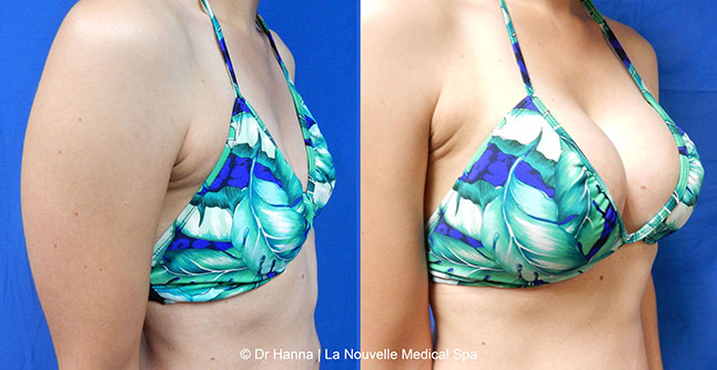breast augmentation with silicone implants before after photos by dr. Hanna, La Nouvelle Medical Spa, Oxnard, Ventura County, 13 