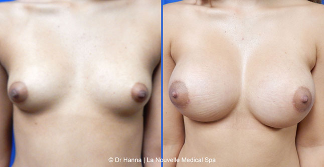 breast augmentation with silicone implants before after photos by dr. Hanna, La Nouvelle Medical Spa, Oxnard, Ventura County, 