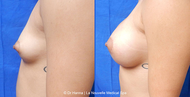 breast augmentation with silicone implants before after photos by dr. Hanna, La Nouvelle Medical Spa, Oxnard, Ventura County, 16 