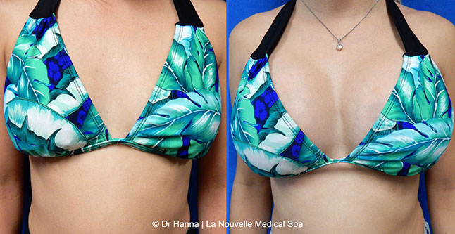 breast augmentation with silicone implants before after photos by dr. Hanna, La Nouvelle Medical Spa, Oxnard, Ventura County, 17 