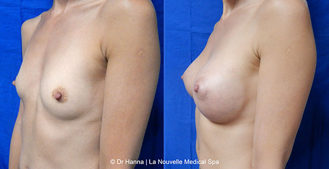 breast augmentation with silicone implants before after photos by dr. Hanna, La Nouvelle Medical Spa, Oxnard, Ventura County, 2