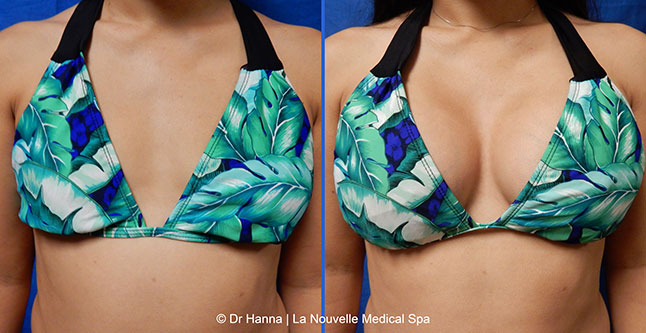 breast augmentation with silicone implants before after photos by dr. Hanna, La Nouvelle Medical Spa, Oxnard, Ventura County, 21