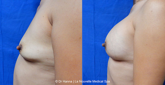breast augmentation with silicone implants before after photos by dr. Hanna, La Nouvelle Medical Spa, Oxnard, Ventura County, 23