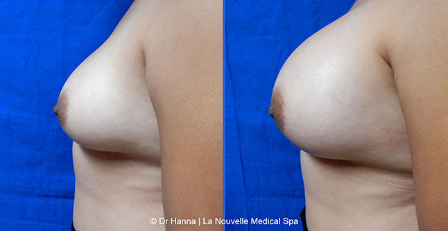 breast augmentation with silicone implants before after photos by dr. Hanna, La Nouvelle Medical Spa, Oxnard, Ventura County, 24