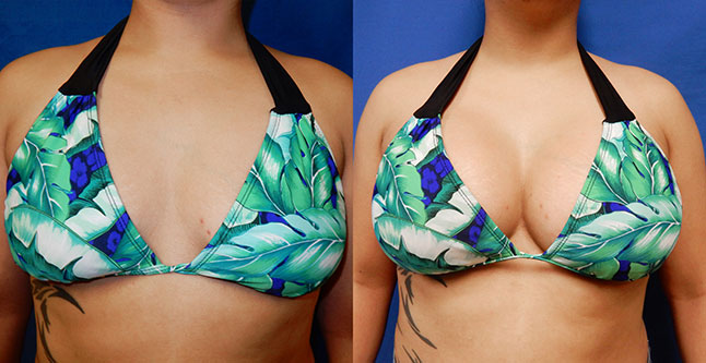 breast augmentation with silicone implants before after photos by dr. Hanna, La Nouvelle Medical Spa, Oxnard, Ventura County, 26