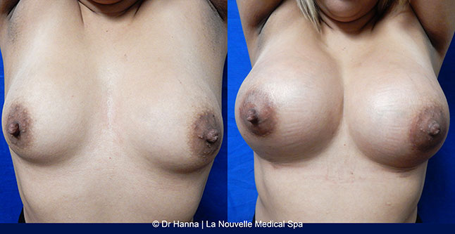 breast augmentation with silicone implants before after photos by dr. Hanna, La Nouvelle Medical Spa, Oxnard, Ventura County, 27