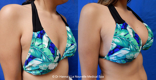breast augmentation with silicone implants before after photos by dr. Hanna, La Nouvelle Medical Spa, Oxnard, Ventura County, 29 