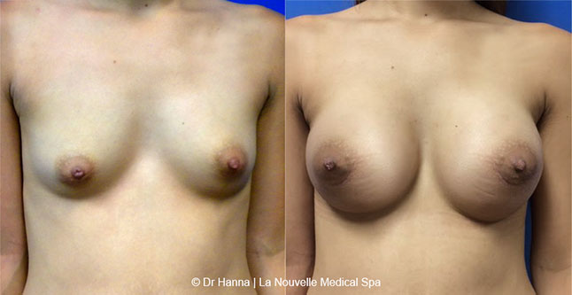 breast augmentation with silicone implants before after photos by dr. Hanna, La Nouvelle Medical Spa, Oxnard, Ventura County, 3 