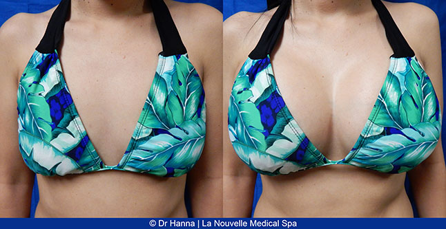 breast augmentation with silicone implants before after photos by dr. Hanna, La Nouvelle Medical Spa, Oxnard, Ventura County, 30 