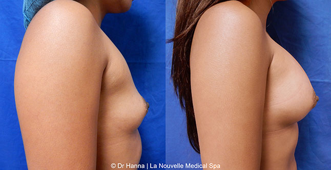 breast augmentation with silicone implants before after photos by dr. Hanna, La Nouvelle Medical Spa, Oxnard, Ventura County, 31 