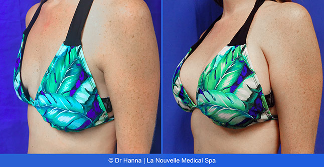 breast augmentation with silicone implants before after photos by dr. Hanna, La Nouvelle Medical Spa, Oxnard, Ventura County, 33 