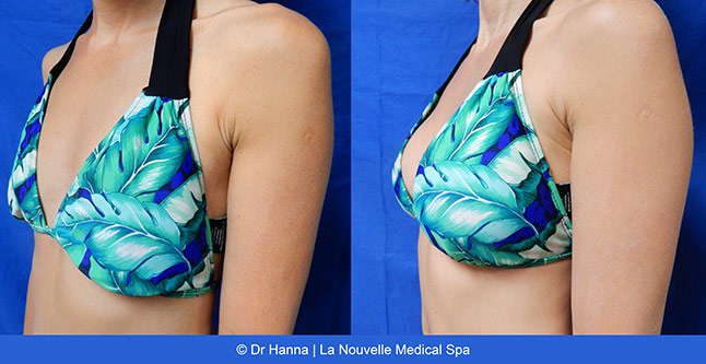 breast augmentation with silicone implants before after photos by dr. Hanna, La Nouvelle Medical Spa, Oxnard, Ventura County, 34 