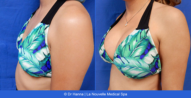 breast augmentation with silicone implants before after photos by dr. Hanna, La Nouvelle Medical Spa, Oxnard, Ventura County, 35 