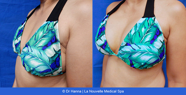breast augmentation with silicone implants before after photos by dr. Hanna, La Nouvelle Medical Spa, Oxnard, Ventura County, 36