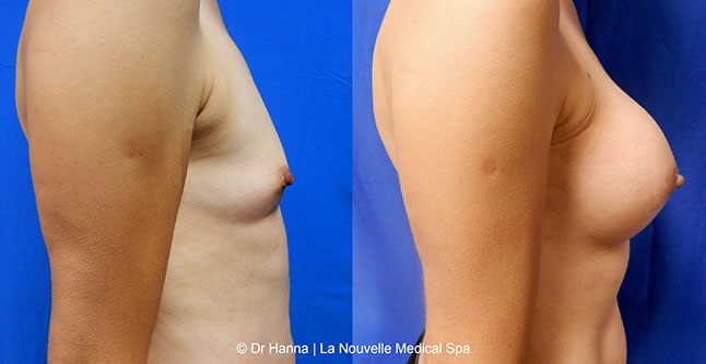 breast augmentation with silicone implants before after photos by dr. Hanna, La Nouvelle Medical Spa, Oxnard, Ventura County, 4 