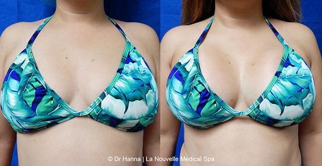 breast augmentation with silicone implants before after photos by dr. Hanna, La Nouvelle Medical Spa, Oxnard, Ventura County, 8
