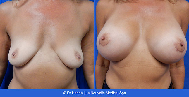 beast lift and breast augmentation with silicone implants before after photos by dr. Hanna, La Nouvelle Medical Spa, Oxnard, Ventura County, 22